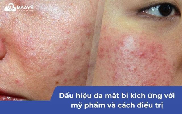 da mặt bị kích ứng